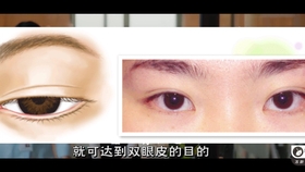 双眼皮新技术揭秘，小明的魔法双眼皮之旅